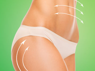 Safety and efficacy of multipolar RF in the treatment of abdominal cellulitis